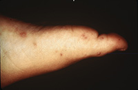 Hand-foot-and-mouth disease